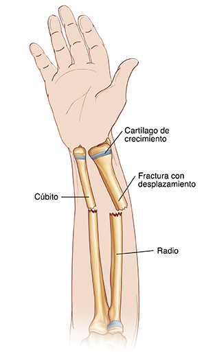 Krames Online Qu Hacer Si Su Hijo Tiene Una Fractura En El Antebrazo