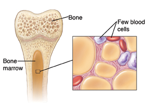 Cross-section of bone showing marrow and inset of marrow with aplastic anemia.