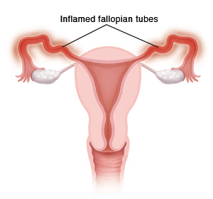 Cross section front view of vagina, uterus, fallopian tubes, and ovaries. Fallopian tubes are inflamed.