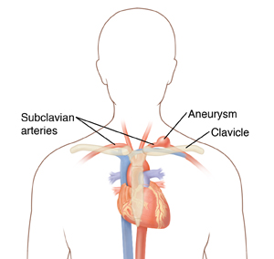 Outline of head and chest showing heart, arteries, clavicle, sternum and subclavian aneurysm.
