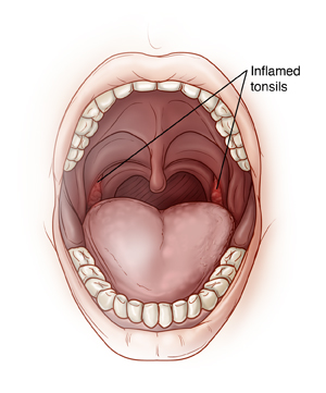 Open mouth showing inflamed tonsils.