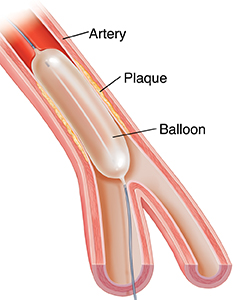 Cross-section of artery showing balloon angioplasty.