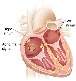 Cross section of heart showing atrial flutter.