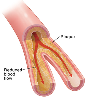 Cross section of artery showing plaque buildup and restricted blood flow.