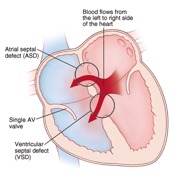 Front view cross section of heart showing atria on top and ventricles on bottom. Atrial septal defect (ASD) is in septum between atria. Ventricular septal defect (VSD) is in septum between ventricles. There is only one AV valve. Arrows show blood flowing from left to right side of heart.