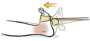 Foot with elastic band tied around forefoot doing ankle dorsiflexion exercise.