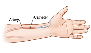 Front view of palm of the hand and forearm showing arterial line in radial artery.