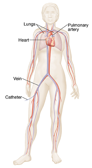 Front view of female outline showing heart, lungs, major arteries and veins. Catheter inserted in femoral vein going to heart. 