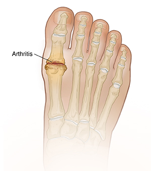 Top view of foot showing arthritis in big toe joint.