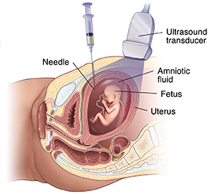 Side view of pregnant woman showing fetus, ultrasound probe, and needle taking sample of amniotic fluid for amniocentesis.