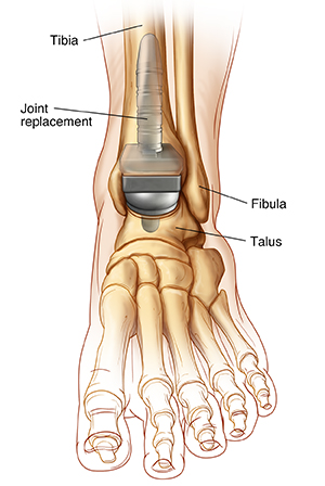 Front view of ankle and foot bones showing ankle replacement.