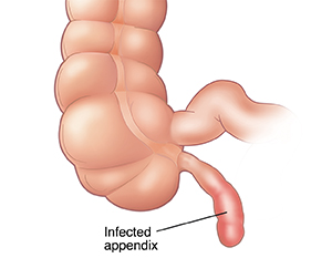 Front view of an infected appendix.