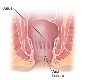 Cross section of anus showing anal fissure.