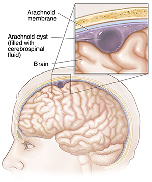 Side view of head and brain with a close up of an arachnoid cyst.