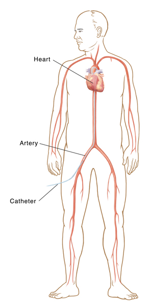 Male figure showing heart and arteries. Catheter goes from artery in thigh to heart.