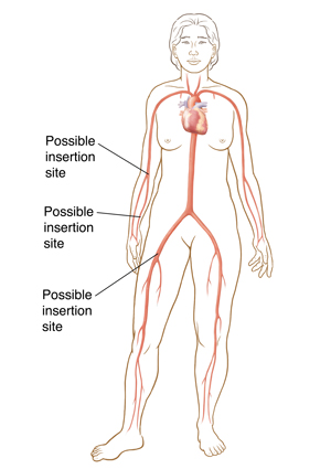 Silhouette of woman showing catheter insertion sites in groin and arm.