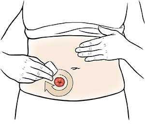 Primer plano de un abdomen donde pueden verse manos que aplican una barrera cutánea alrededor del estoma.
